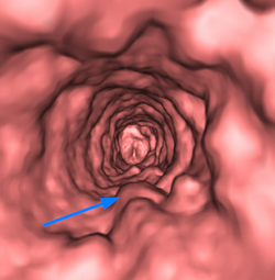 CT tracheal papillomatosis volume.png