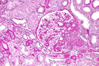 Focal segmental glomerulosclerosis - high mag.jpg