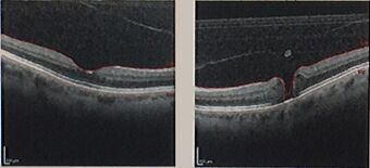 Macular Hole side x side.jpg