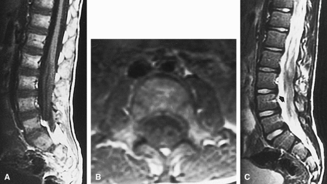 Medicine:Dejerine–Sottas disease - HandWiki