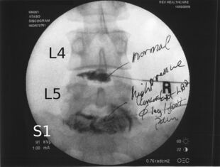 Discograph degenerative disc disease L5-S1.jpg