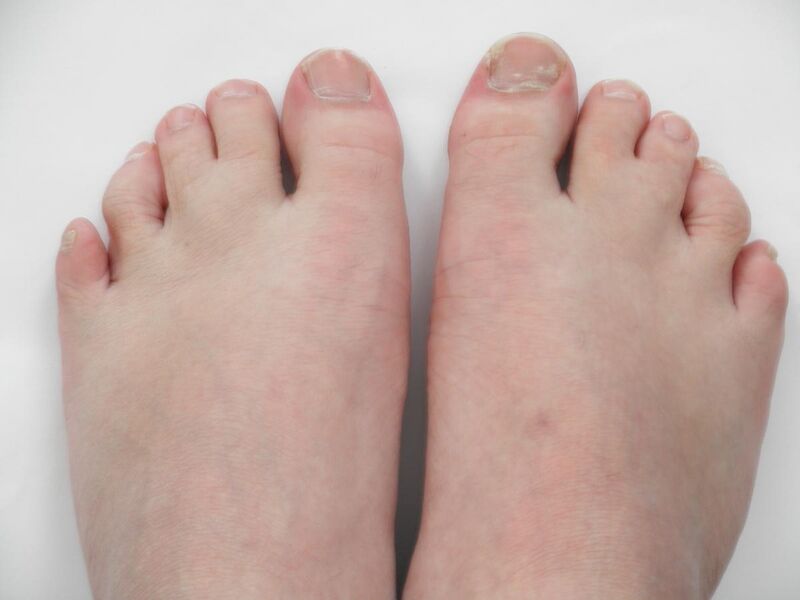 File:Feets with partial simple syndactyly.jpg
