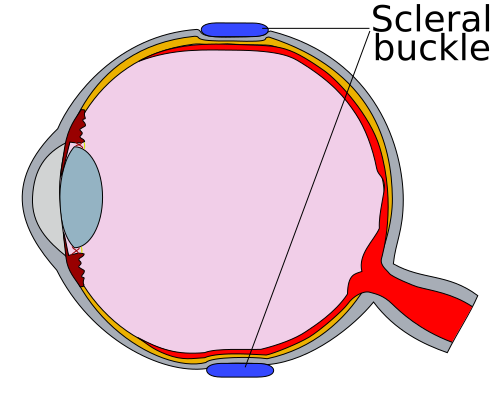 File:Human eye cross section scleral buckle.svg