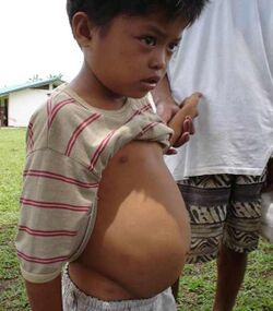 Schistosomiasis in a child 2.jpg
