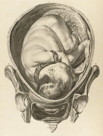 Tab IX; Foetus in utero with umbilical cord wrapped Wellcome L0064782 (cropped).jpg
