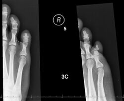 X-rays of foot phalanx.jpg