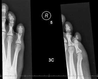 X-ray shows a small portion broken off the corner of the distal bone, and a [more longitudinal fracture in the bone in the middle of the toe?},