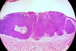 Basal Cell Carcinoma, Nodular Pattern (6032028849).jpg