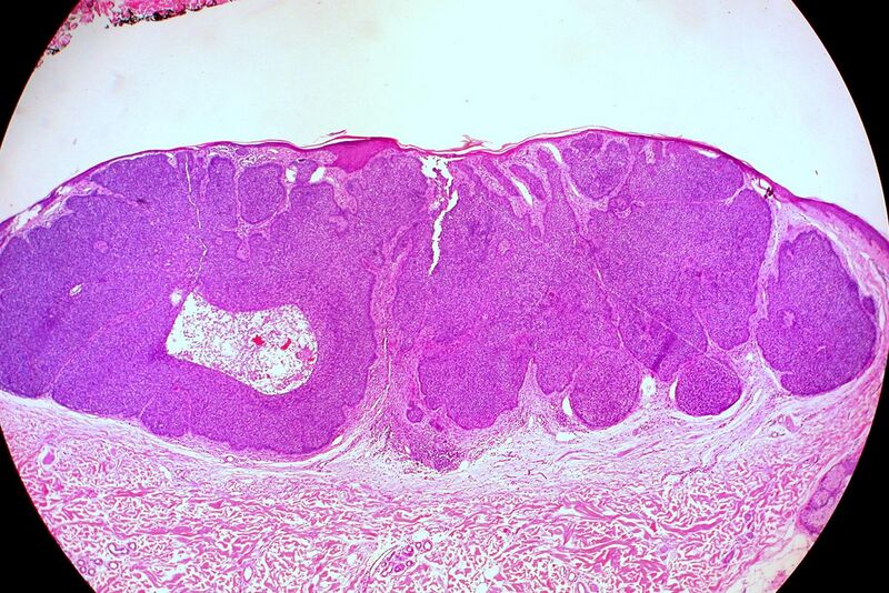 File:Basal Cell Carcinoma, Nodular Pattern (6032028849).jpg