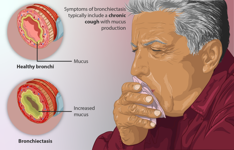 File:Depiction of a person suffering from Bronchiectasis.png