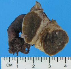 Gross pathology of a Leydig cell tumor of ovary.jpg
