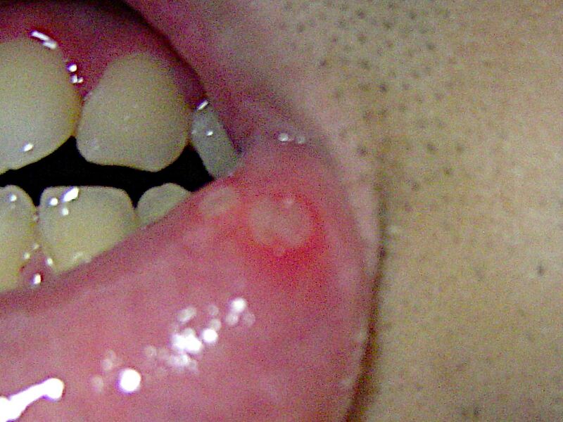 File:Aphthous ulcer.jpg