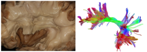 Arcuate fasciculus dissection and tractography.png