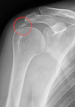 Calcific tendinitis marked.jpg