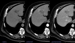 Fetthaltiges HCC 68jm - CT nativ arteriell portalvenoes.jpg