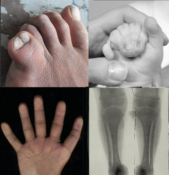 Tibial hemimelia-polysyndactyly-triphalangeal thumb syndrome.png