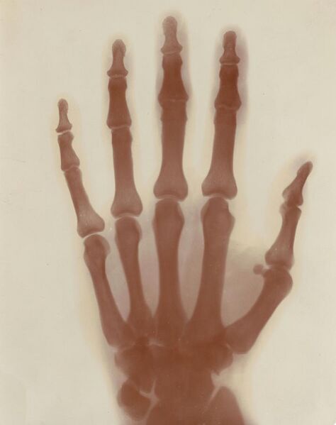 File:X-Ray Photograph of Tesla's left hand.jpg