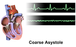 Asystole Coarse.png