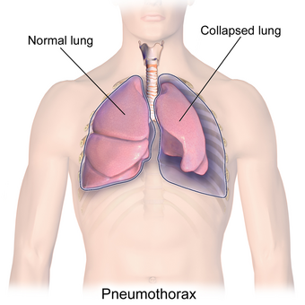 Blausen 0742 Pneumothorax.png