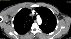 CT pyomyositis.jpg