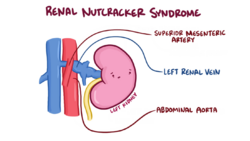 Nutcracker Syndrome Anatomy.png