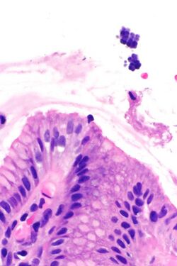 Gastritis with Sarcina - a1 - very high mag.jpg