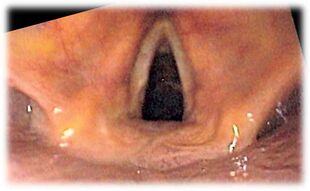 View of the glottis as seen during laryngoscopy