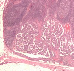 Lymph node with papillary thyroid carcinoma.jpg
