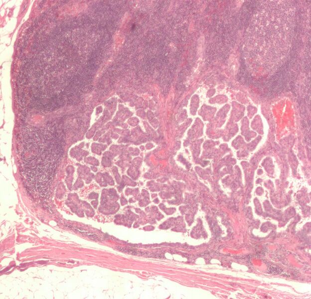 File:Lymph node with papillary thyroid carcinoma.jpg