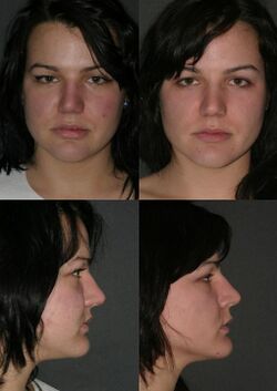 Before & After Buccal Fat Extraction.JPG