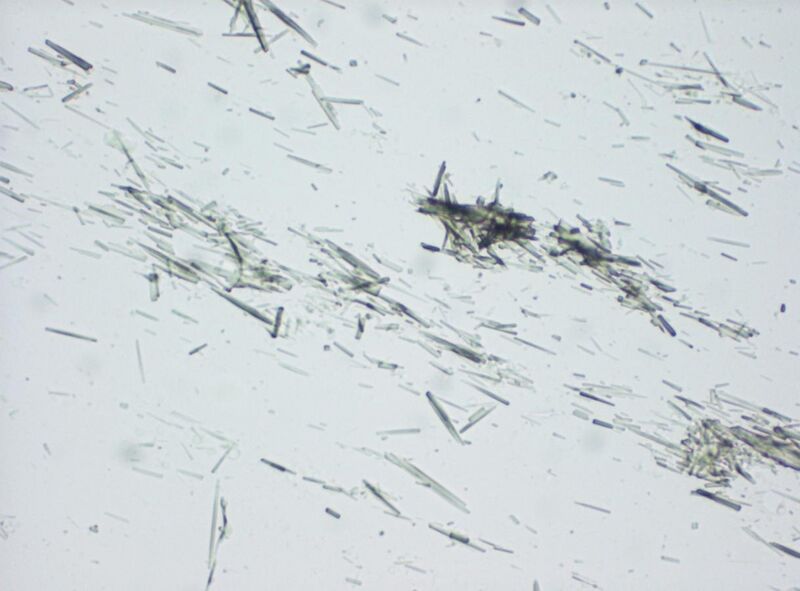 File:Light microscopy of a touch preparation of a gout tophus, showing urate crystals.jpg