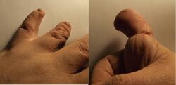 Amniotic Band Syndrome 26 Year old Male.jpg