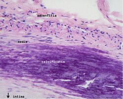 Calcificatio atherosclerotica.jpg