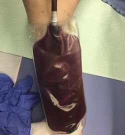 PurpleUrine.jpg