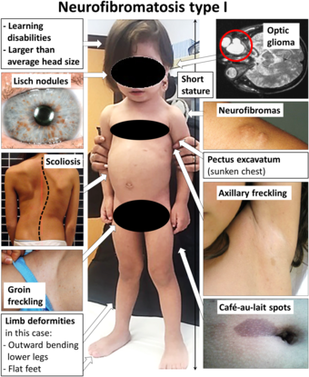 Symptoms of neurofibromatosis type 1 - censored version.png