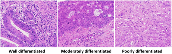 Well-, moderately and poorly differentiated colorectal adenocarcinoma.png