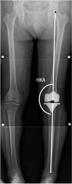 File:X-ray of HKA angle with knee prosthesis.jpg