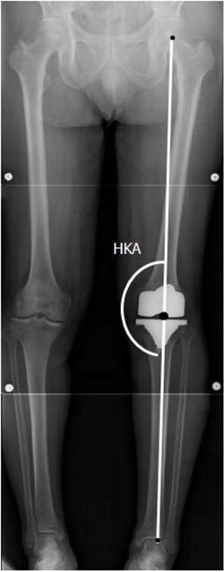 X-ray of HKA angle with knee prosthesis.jpg
