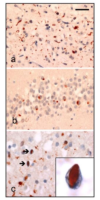 Histology of frontotemporal lobar degeneration.jpg