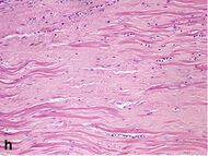 Histopathology of dense fibrous scar replacing myocyte loss in myocardial infarction.jpg