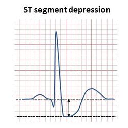 ST depression illustration.jpg