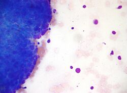 Thymoma - cytology high mag.jpg