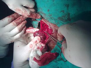Thyroid Surgery.jpg