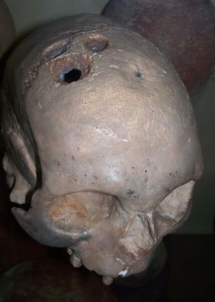 File:Trepanated skull, Bronze Age.JPG
