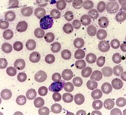 Plasmodium vivax malaria.jpg