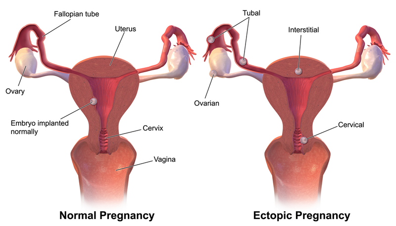 File:Ectopic Pregnancy.png