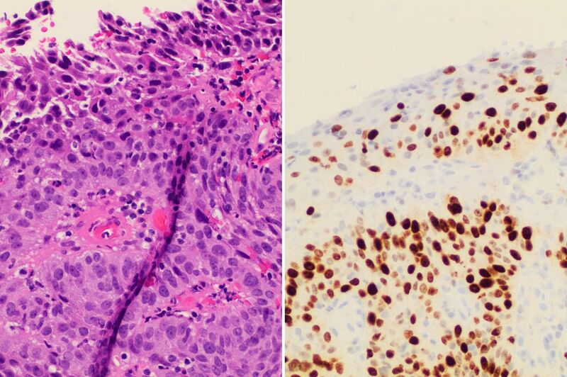 File:Invasive cervical squamous cell carcinoma on H&E histopathology and Ki-67 immunohistochemistry.jpg