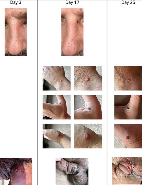 File:Monkeypox lesion progression.jpg