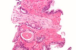 Prostatic adenocarcinoma with perineural invasion.JPG