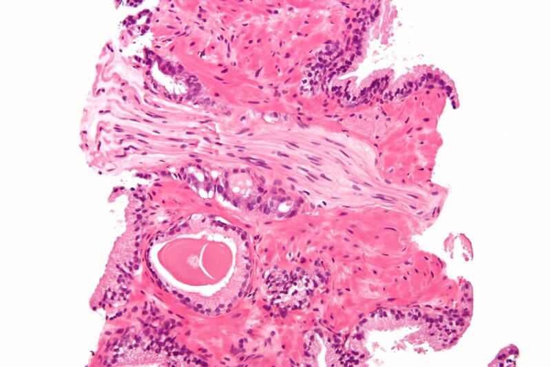 File:Prostatic adenocarcinoma with perineural invasion.JPG